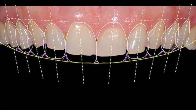 https://dentalexcellenceturkey.com/blog/wp-content/uploads/2022/03/digital-smile-design1-img.jpeg