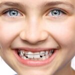 چه سنی برای ارتودنسی کودکان مناسب است؟