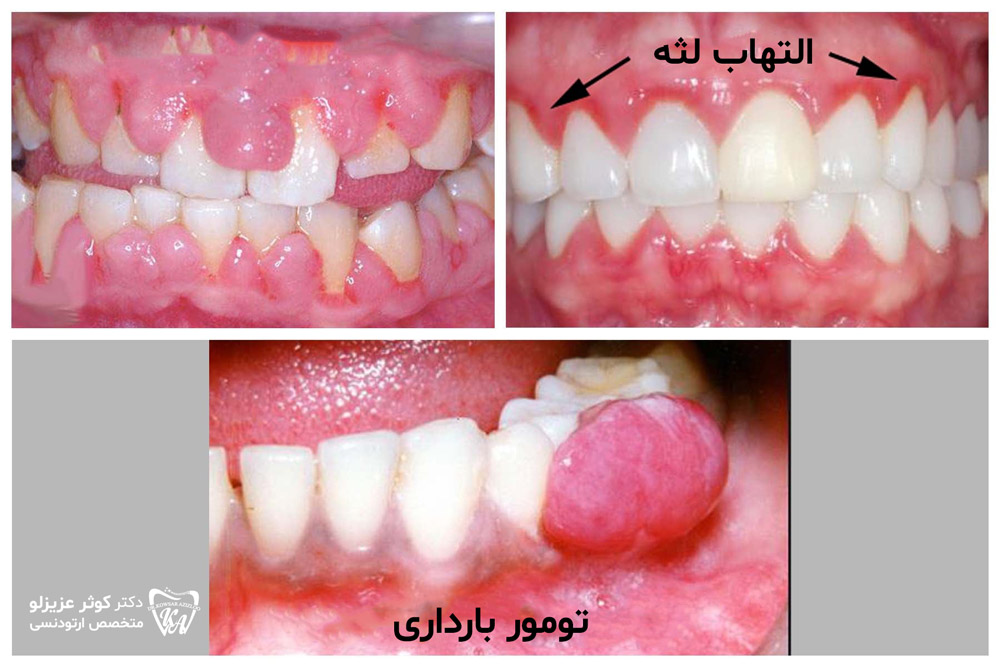 تومور بارداری لثه