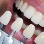 کامپوزیت یا ارتودنسی ؛ کدام یک برای دندان های شما بهتر است ؟