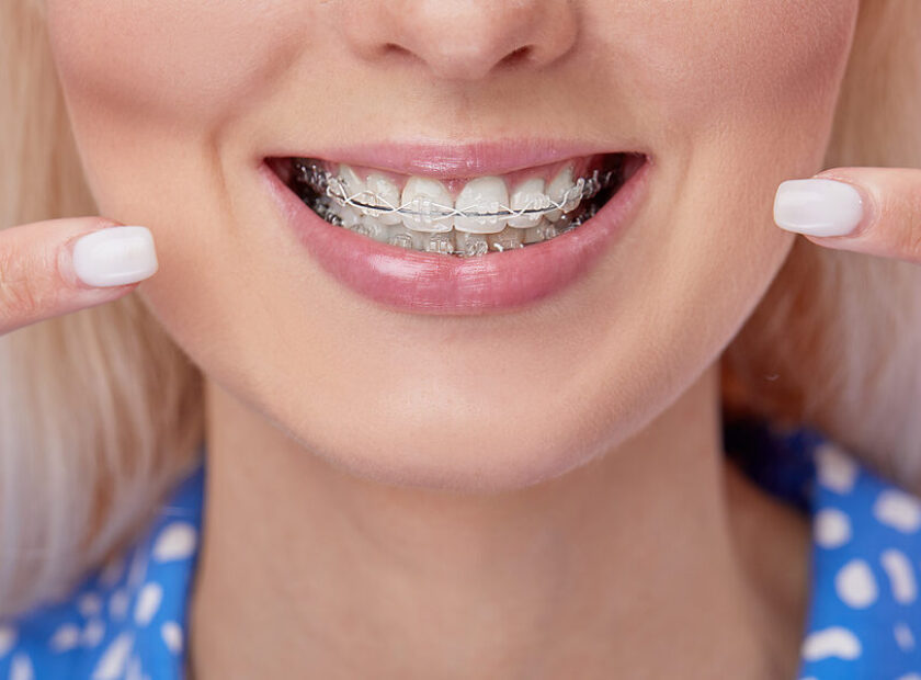 Beautiful Macro Shot Of White Teeth With Braces. Dental Care Pho