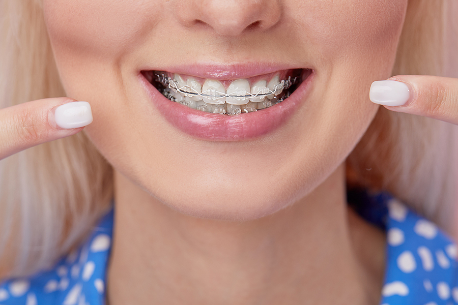 Beautiful Macro Shot Of White Teeth With Braces. Dental Care Pho