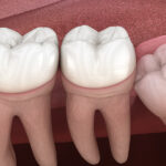 درمان ارتودنسی دندان نهفته چیست و چه کاربردی دارد؟
