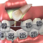 علت نهفتگی دندان نیش چیست؛ آیا ارتودنسی برای آن راهکاری دارد؟