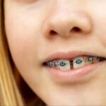 درمان ارتودنسی در بستن فواصل بین دندانی