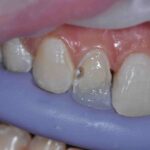 کامپوزیت دندان به روش لیرینگ چگونه انجام می‌شود؟