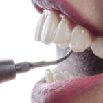 چرا قبل از ارتودنسی انجام جرمگیری دندان ضروری است؟