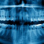 روش های درمان نهفتگی دندان با ارتودنسی