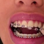 اولین ویزیت ارتودنسی را در چه سنی انجام دهیم؟( بررسی پاسخ دکتر عزیزلو)
