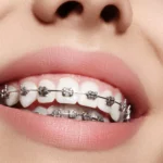 کامپوزیت دندان یا ارتودنسی؟ کدام بهتر است؟