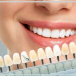 پاسخ به سوالات متداول درباره کامپوزیت دندان
