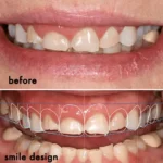 اصلاح طرح لبخند با لمینت | جدیدترین تکنیک‌های زیبایی در کلینیک دکتر عزیزلو سعادت‌آباد