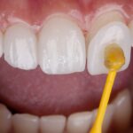 لمینت دندان بدون تراش در سعادت‌آباد | تکنیک‌های نوین توسط دکتر عزیزلو