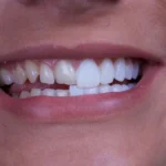 راهنمای کامل انتخاب بهترین نوع لمینت دندان در سعادت‌آباد