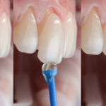 آیا لمینت دندان دائمی است؟ بررسی تخصصی توسط دکتر عزیزلو در سعادت‌آباد