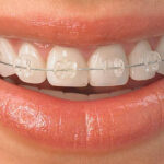 ارتودنسی نامرئی یا براکت فلزی؟ مقایسه کامل برای انتخاب بهترین روش درمان