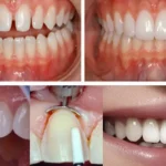 مراحل انجام لمینت دندان در کلینیک دکتر عزیزلو در سعادت‌آباد