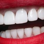 بهترین روش لمینت دندان در سعادت‌آباد | تجربه لبخند هالیوودی با دکتر عزیزلو