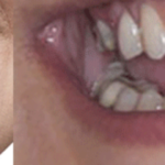 آیا فاصله و نامرتبی دندانها بدون ارتودنسی قابل اصلاح است؟