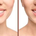 هزینه اصلاح فاصله دندان بدون ارتودنسی چقدر است؟