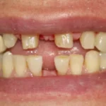 آیا درمان فاصله دندان بدون ارتودنسی برگشت‌پذیر است؟