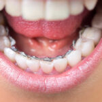 آیا اصلاح نامرتبی دندان بدون ارتودنسی به دندان آسیب میزند؟