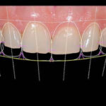آیا درمان زیبایی جایگزین ارتودنسی می‌شود؟