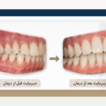 دیپبایت در بزرگسالان؛ چه زمانی با ارتودنسی درمان میشود و چه زمانی جراحی لازم است؟
